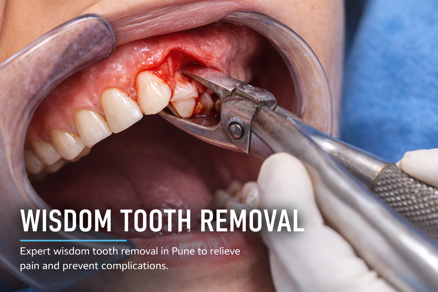 Wisdom Tooth Removal Pune
