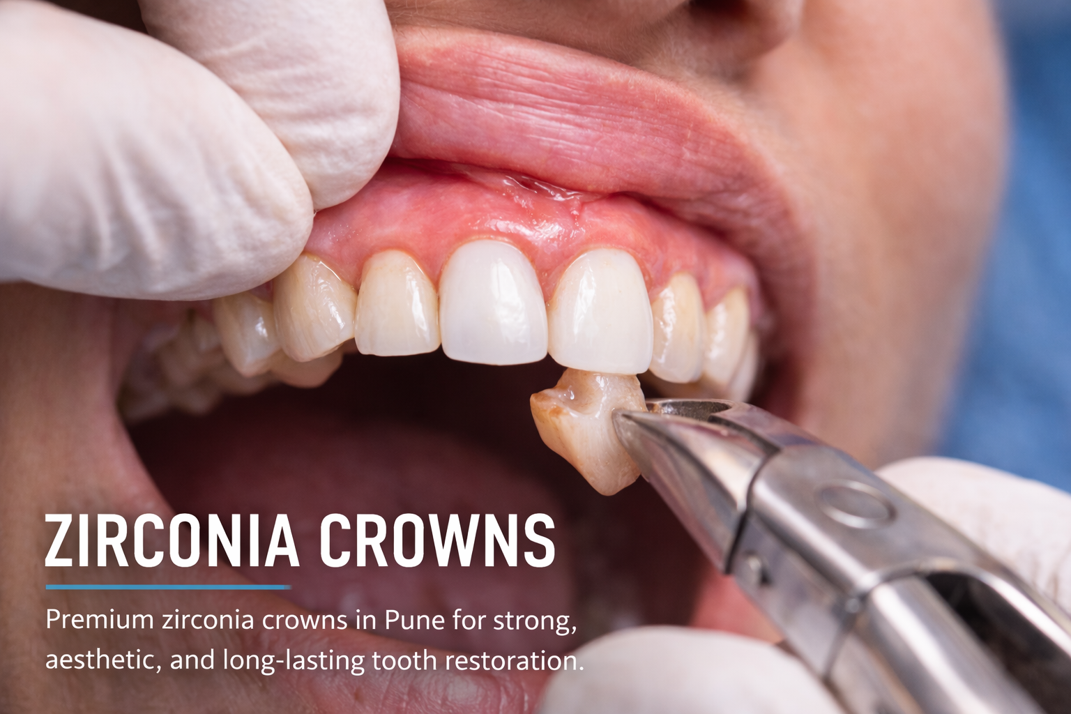 Zirconia Crowns Pune